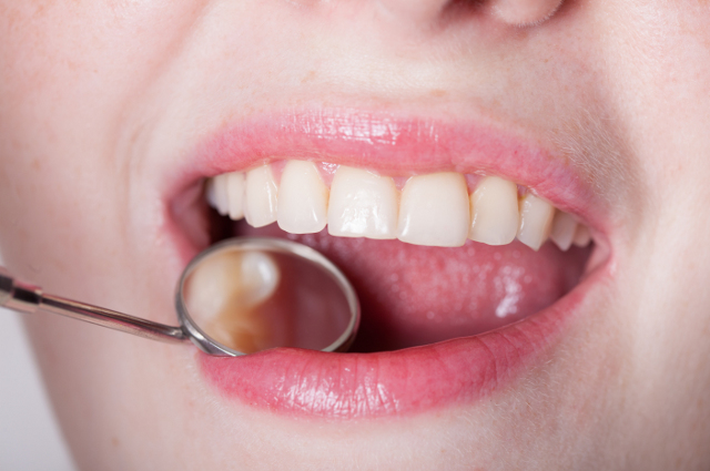 一个女人张开的嘴，牙齿镜在里面。一位塔夫茨的牙医解释了什么是牙龈萎缩，以及牙龈移植是如何修复它的。